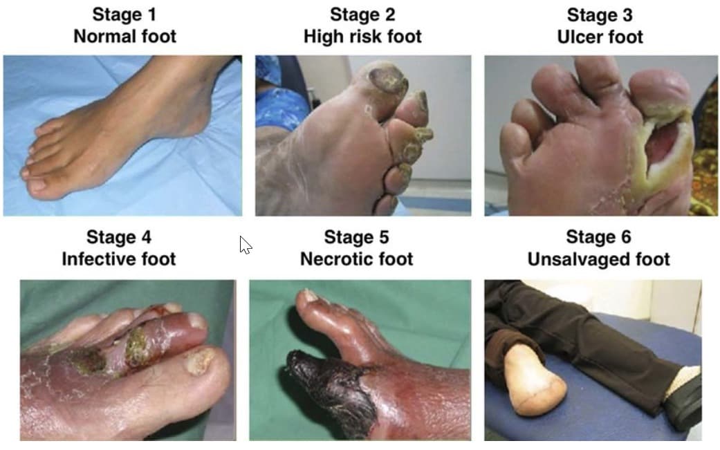 Gangrene Treatment without Surgery